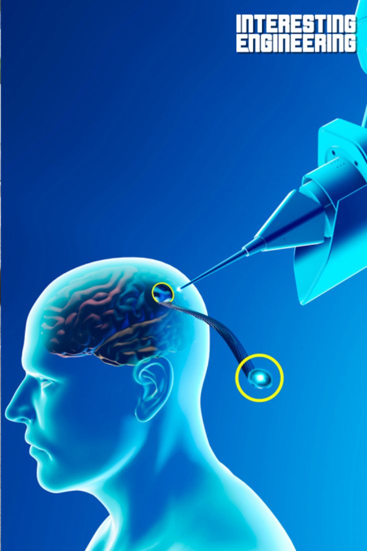 Neuralink: Cos’è e i maggiori dubbi.